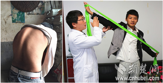 宜昌21岁青年先天脊柱畸形 医院承担10万治疗